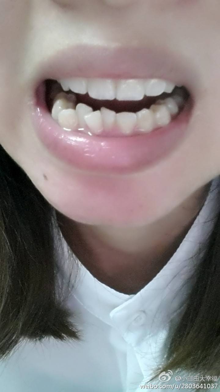 小自由大幸福:24岁了,下面有几颗牙齿不齐很难看,还能做矫正吗?