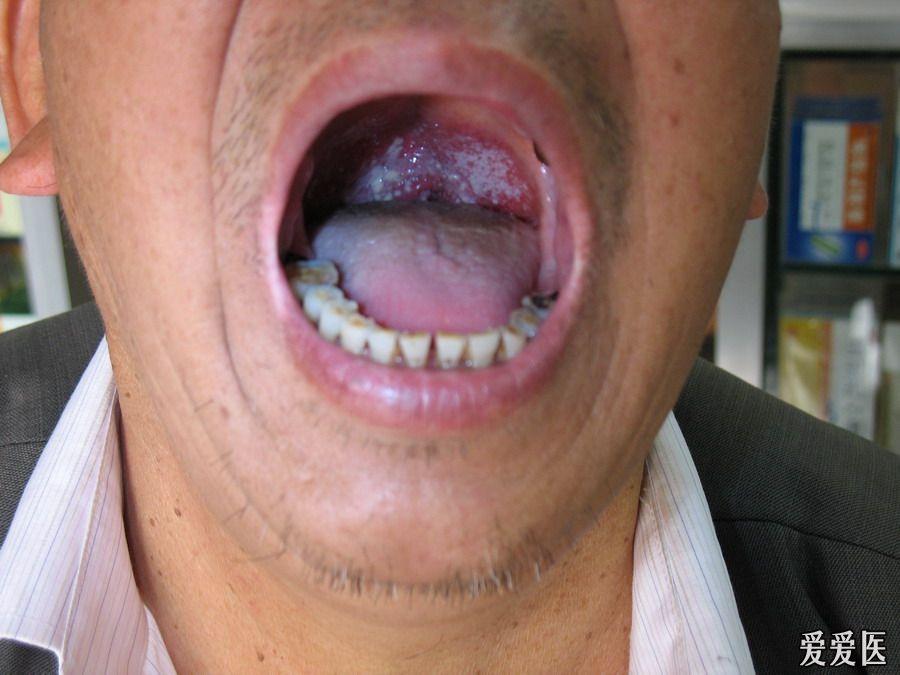 65岁男性 霉菌性口腔炎(治疗效果图片已经上传)