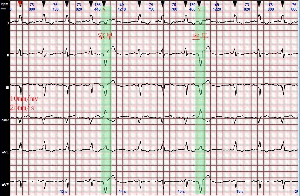 心电图病例分析完全性左束支阻滞