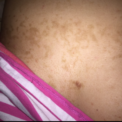 有没有宝妈和我一样,怀孕后乳房下面长褐色的斑,硬硬的,能抠掉皮的,不