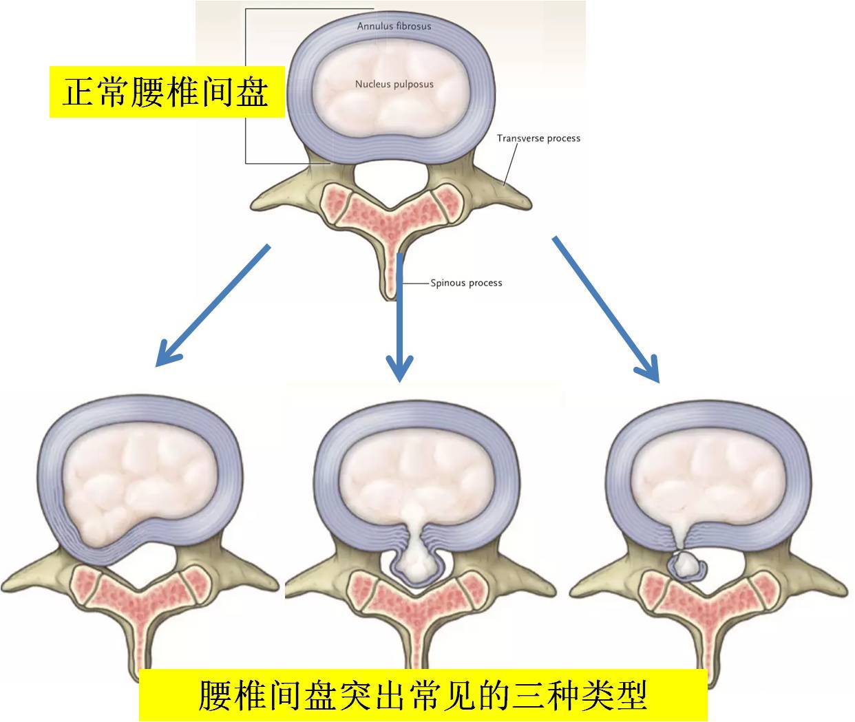 腰椎间盘突出症的症状,检查及治疗_腰椎间盘突出_症状表现_检查_治疗