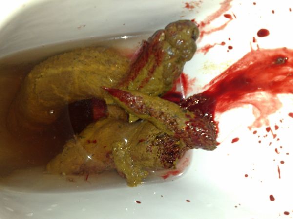 高二学生 最近经常放屁 而且特别多 大便过后有血 颜色鲜红