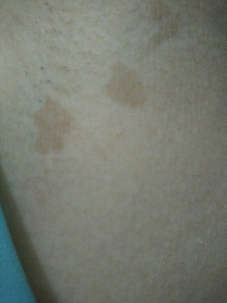 腋下长了褐色斑点,去年有一点点,今年就很明显,没有感觉痒或者不舒服.