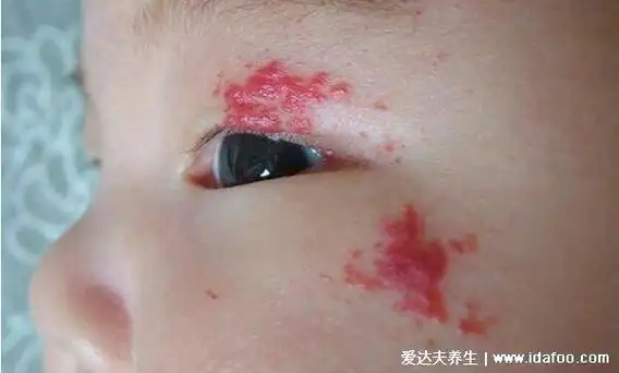 婴儿血管瘤五种类型图片及症状,第5种最常见像红色胎记