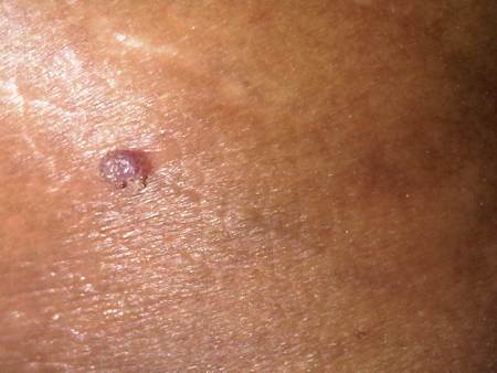 尖锐湿疣长在阴囊皮肤上,阴茎龟头上会有病毒吗?_百度知道