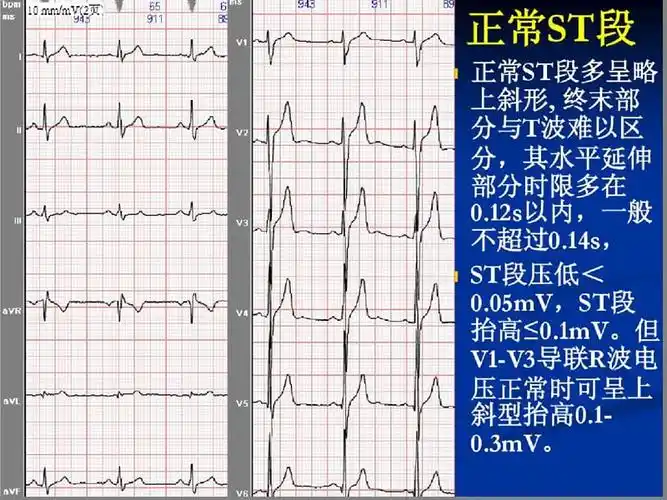 心电图st段抬高的鉴别诊断ppt