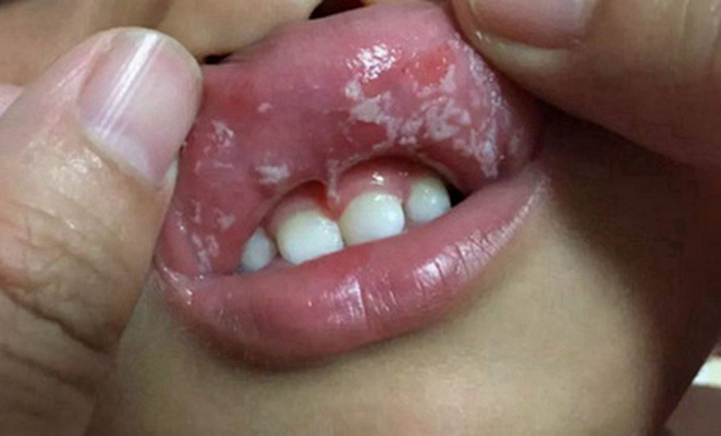 口腔粘膜白斑图片62