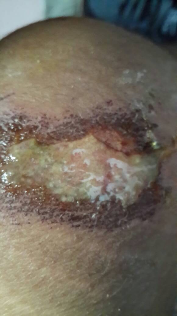 我的膝盖昨天摔伤了,也去医院处理了,现在发现伤口流出一些淡黄色的