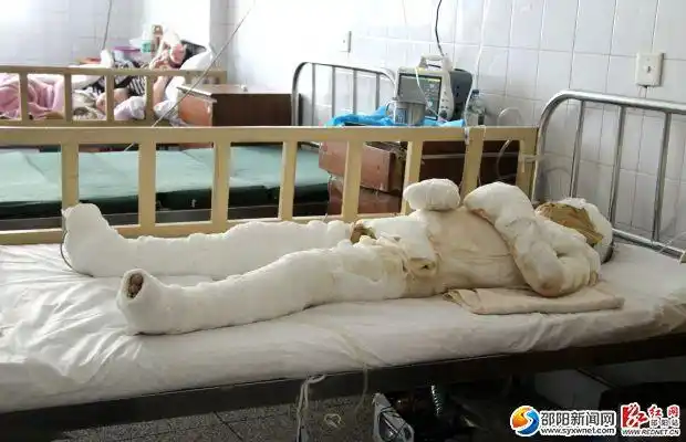 满身纱布包裹着的女孩静静地躺在市中心医院烧伤科11楼1108房20病床上