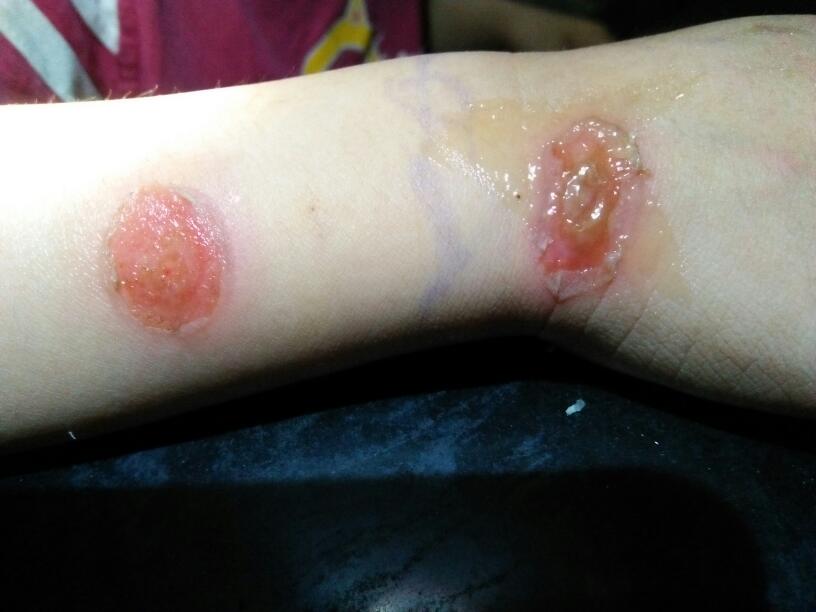 请问我弟弟生什么了?怎么皮肤溃烂了?