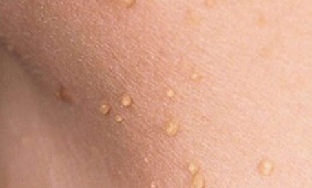 不要把丝状疣当做尖锐湿疣,给自己造成困扰.