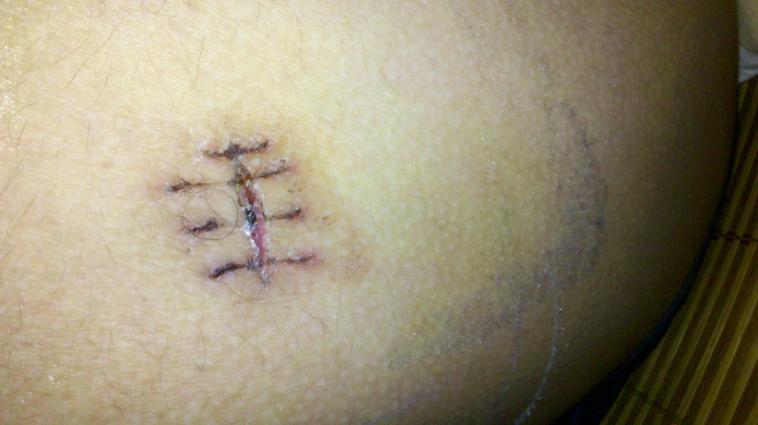 大腿左外侧长了一个大指姆般大小的粉瘤,手术后大概有20天,拆线后大概