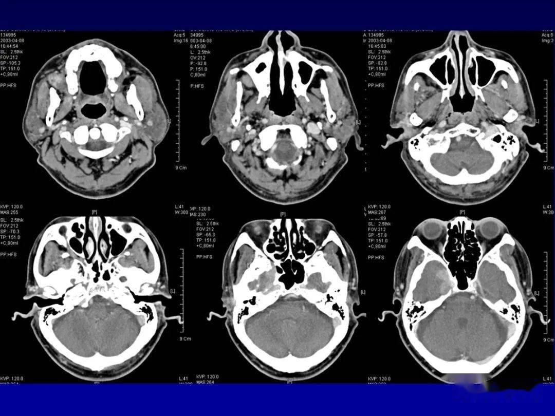 颌面部解剖及其病变的影像诊断