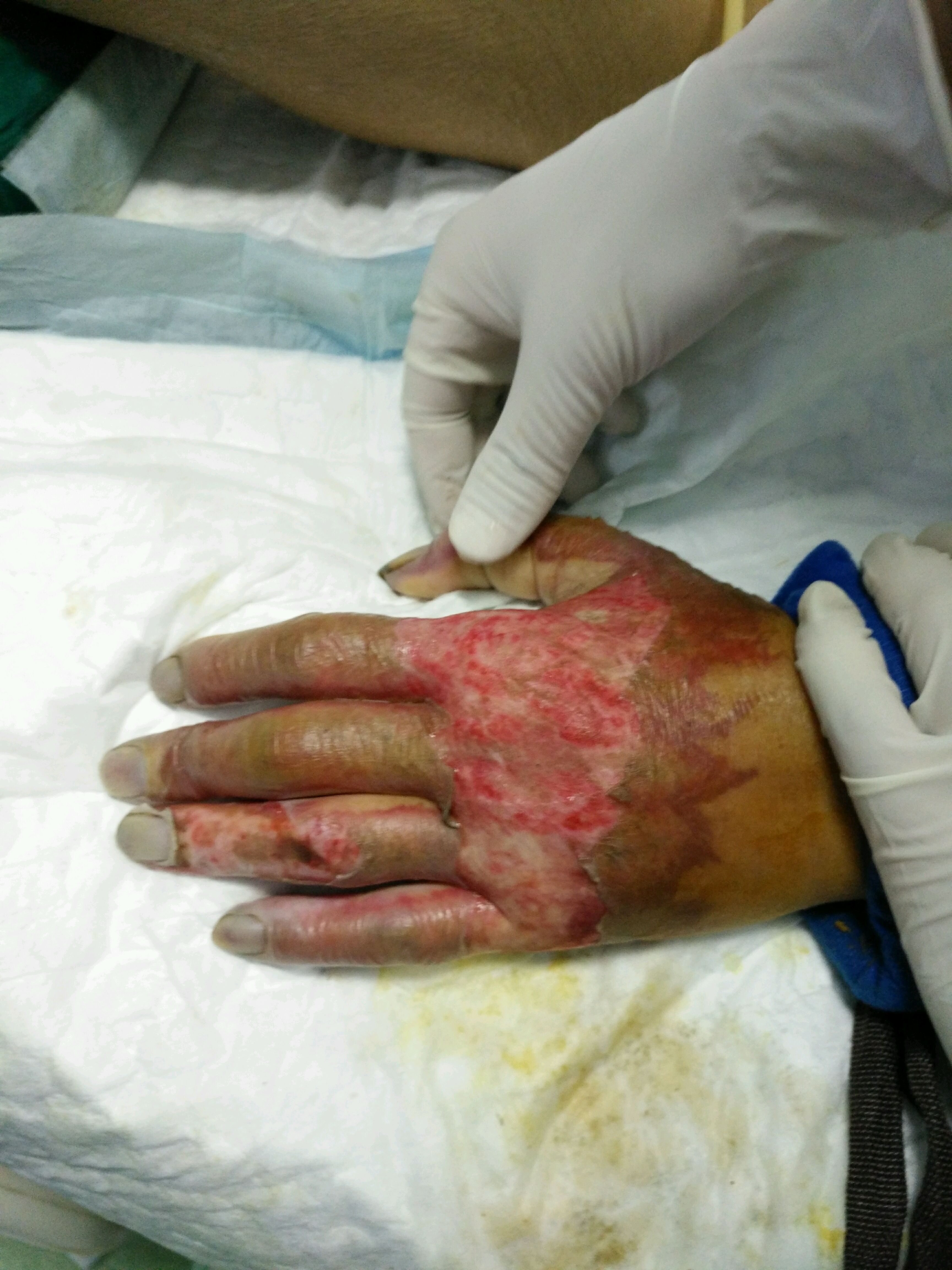 一例重度烧伤病例照片