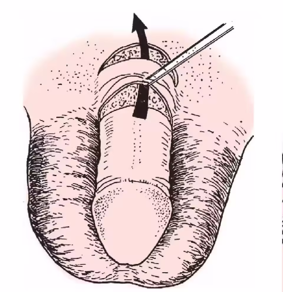 二, 阴茎正位切口矫形术-泌尿外科手术-医学