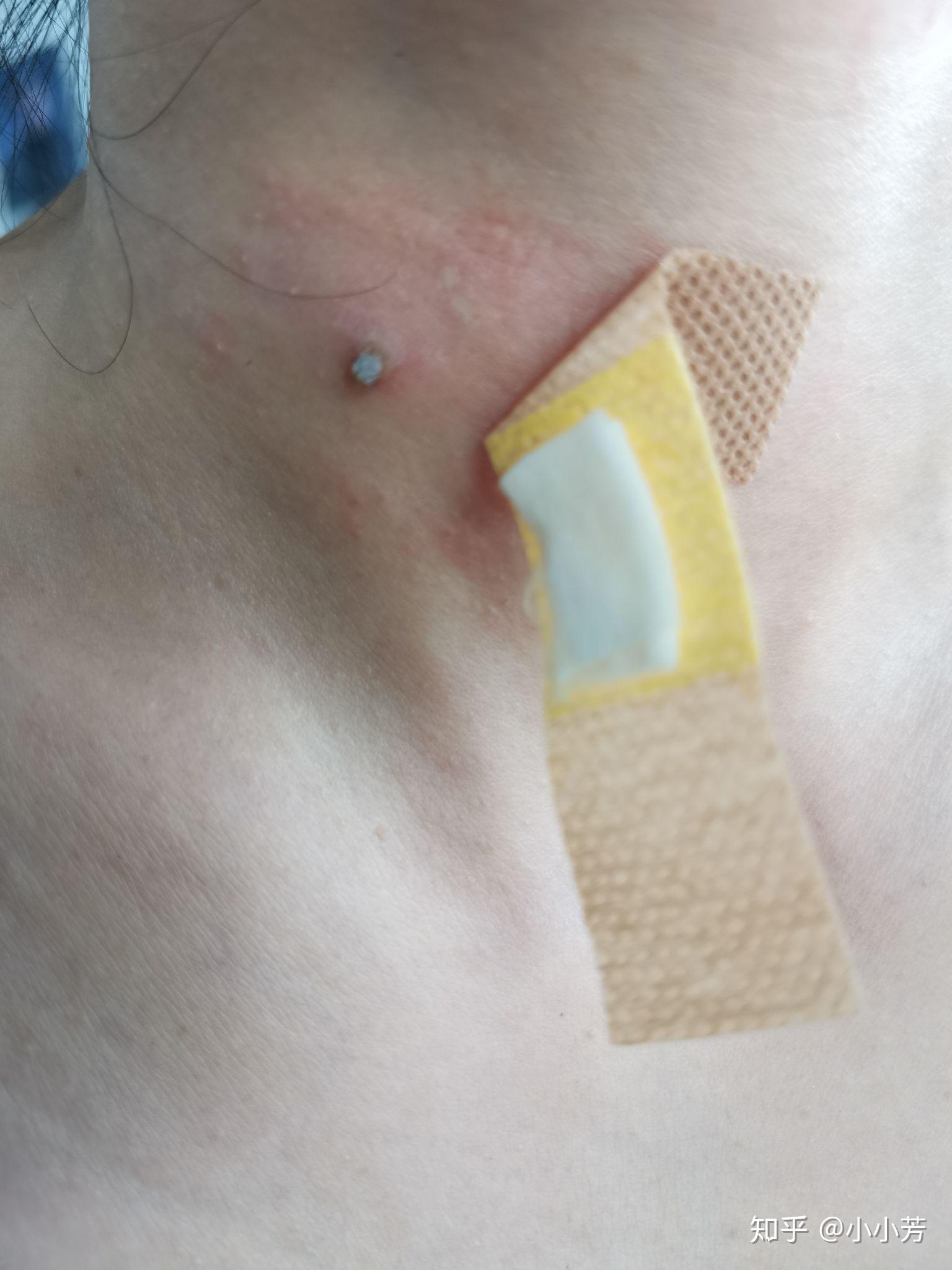 白醋祛除丝状疣