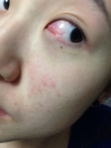 2014-05-31 蔡亚平 医师 眼角膜发炎 晚上流眼泪 晚上起来眼睛很干 有