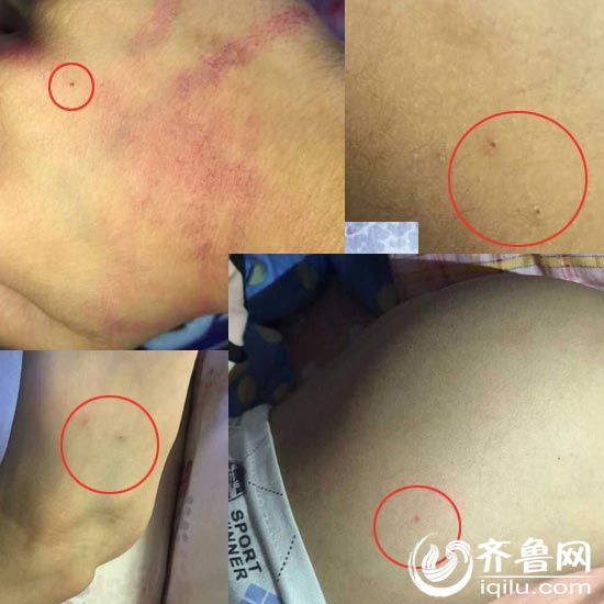 临沂孩子称被幼儿园老师用针扎校方称与己无关