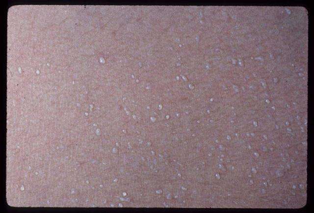 可分为晶状粟粒疹,又名白痱(晶痱),汗管破裂和汗液溢出在角质层内或