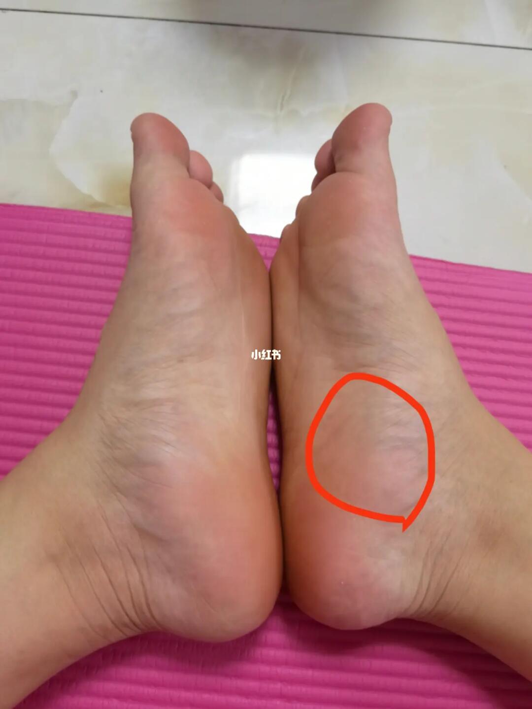 做运动的时候脚掌这块肉疼而且很硬