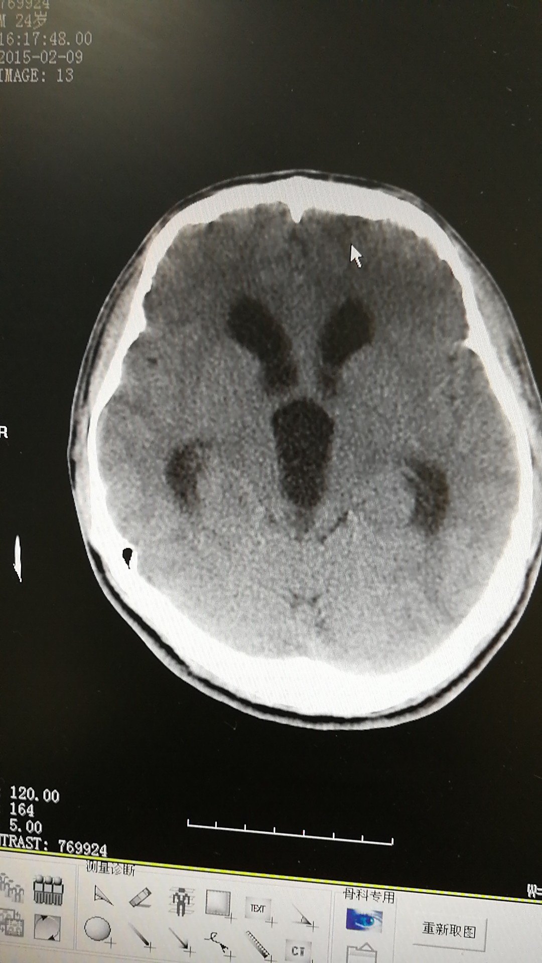 手术后可以明显改善症状,效果明显.脑积水ct显示:侧脑室,三脑室扩大