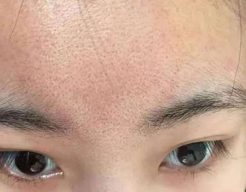 毛孔粗大该怎样改善