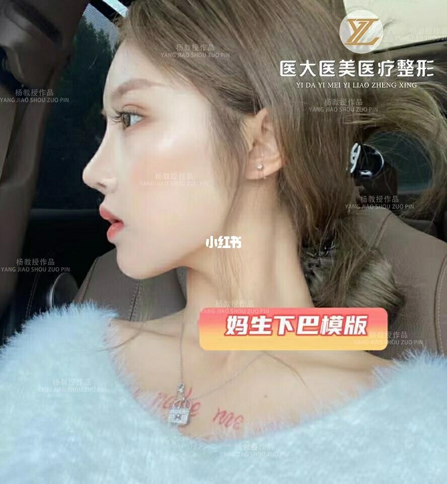 假体下巴案例_美妆_医美_整容_美妆_医美整形