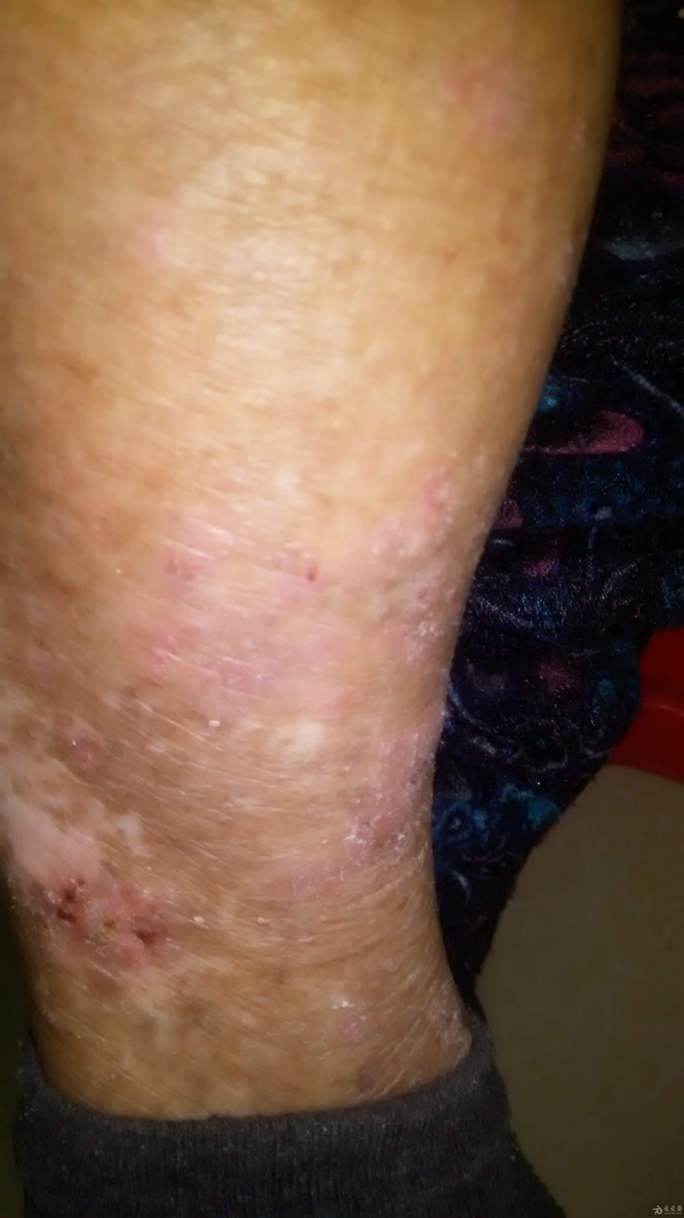 78岁女性患者反复慢性皮肤瘙痒3年