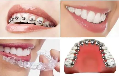 厦门软件园牙齿矫正哪家医院好