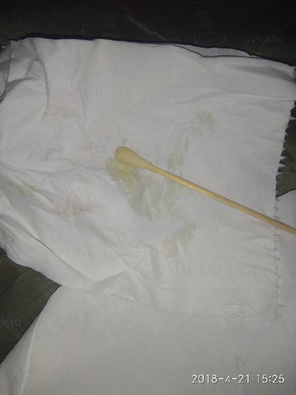 白带糊状 无异味 下面痒 以前有过宫颈糜烂二度 做了普利刀手术后