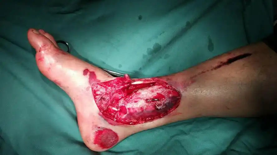 清创后,复位踝关节,克氏针固定,vad覆盖创面