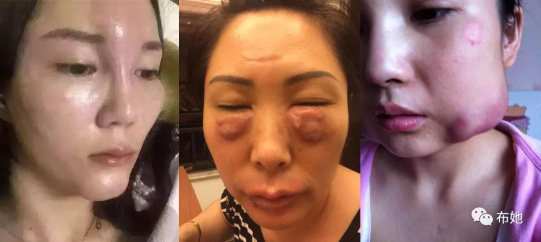 不良微整伤害的重灾区,及修复案例