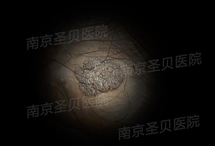 男性菜花状疣高清图片
