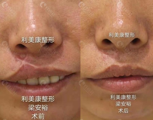 唇腭裂修复手术前后对比照