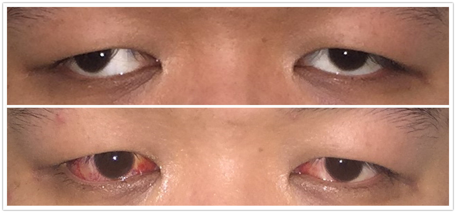 大角度外斜术后外观_眼位