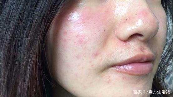 敏感肌百科(2300字)|5种敏感肌护理关键词及7大注意事项