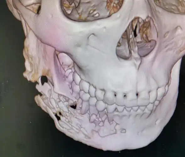 下颌骨化脓性骨髓炎半颌切除3d打 印预制钛板置入重建下颌1例