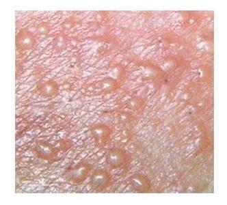 单纯疱疹病毒感染症