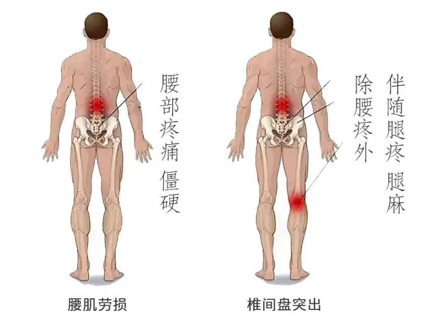腰突和腰椎间盘突出有什么不同?_肌肉_腰部_症状