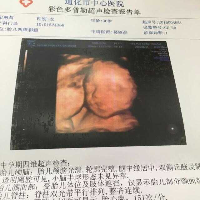 请帮忙看下四维彩超,是兔唇吗?很是担心!