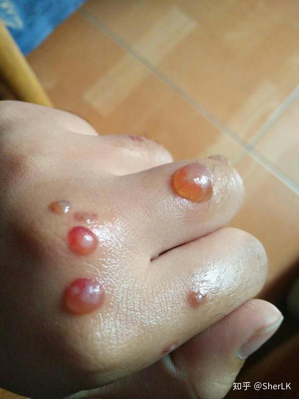 我的扁平疣治好啦