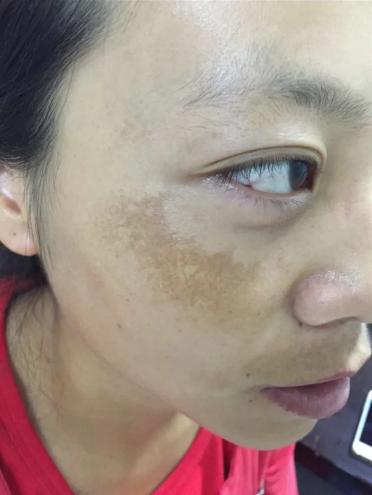 眉山黄褐斑祛除中心浅谈如何能很好的淡化褐斑