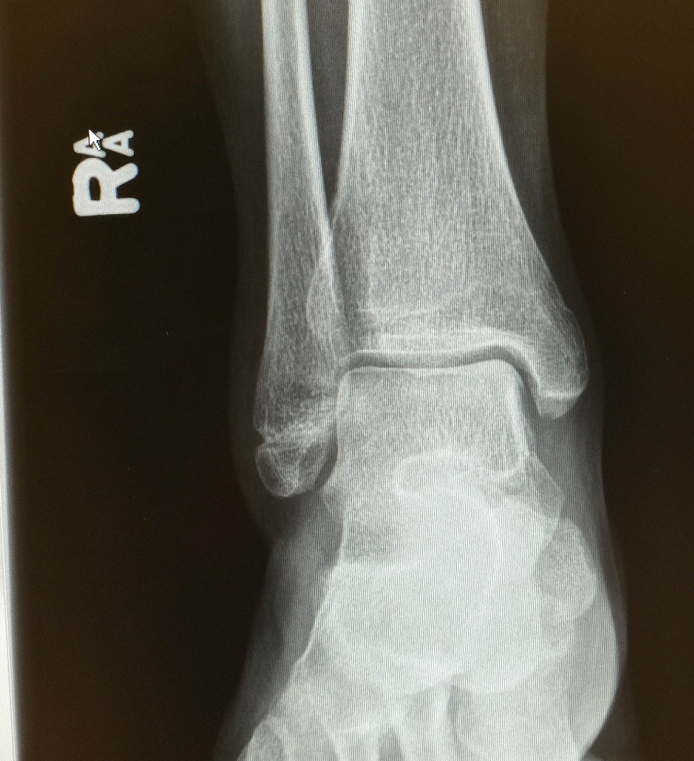 医生您好,今年九月中旬摔倒,把右脚踝的腓骨末端给弄骨裂了,骨_骨折