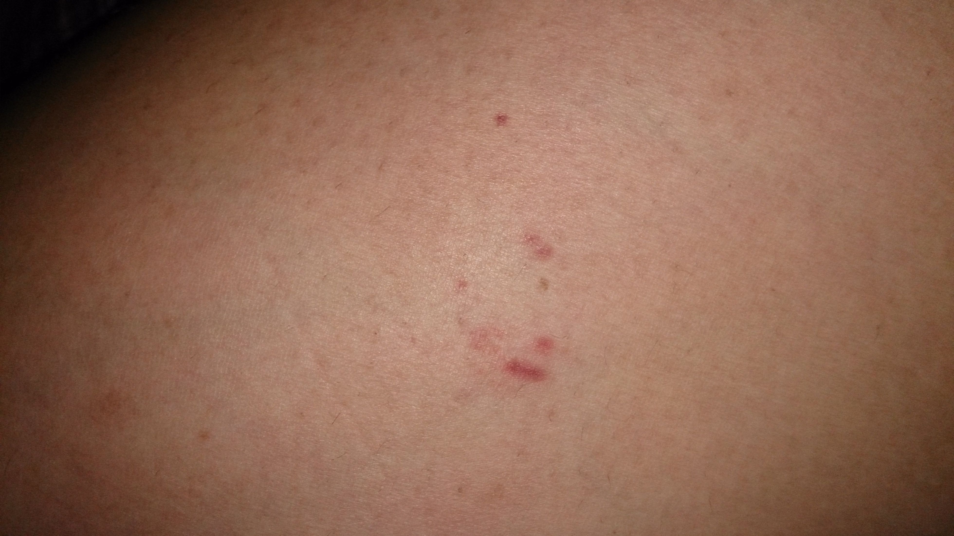 最近身上起了不少小红点,小的只有针眼大小,血红色,不疼不痒,刚发现