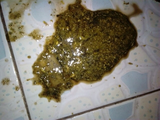 宝宝母乳性腹泻大便呈黑褐色图片