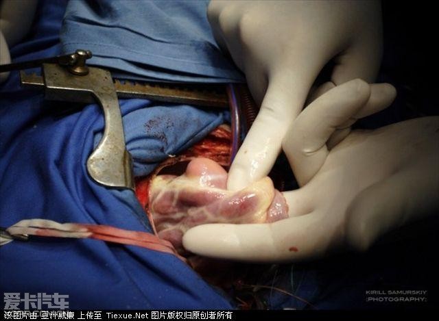 一颗鲜活心脏的手术全过程(血腥)