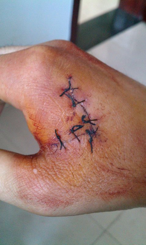 虎口受工伤,大张不开握不紧,且用力时会刺痛.关于鉴定和赔偿