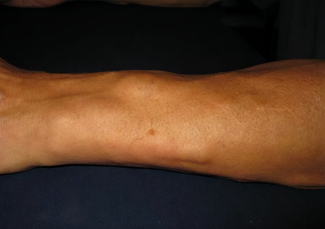 总体来看,大部分脂肪瘤对健康的危害性很小,不属于严重或凶险的疾病.