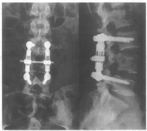 图20-1 l  椎体压缩性骨折行椎管减压复位af固定术后