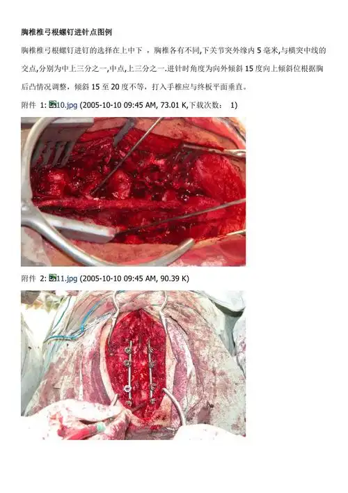 胸椎椎弓根螺钉进针点图例